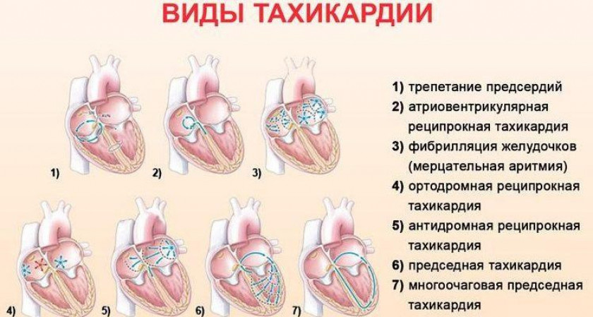 Тахикардия - Изображение 2