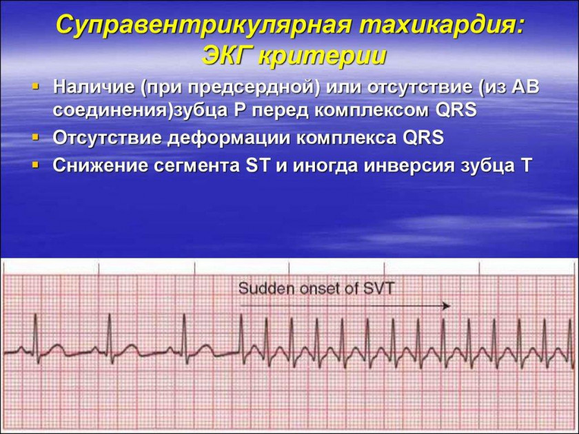 Тахикардия - Изображение 4