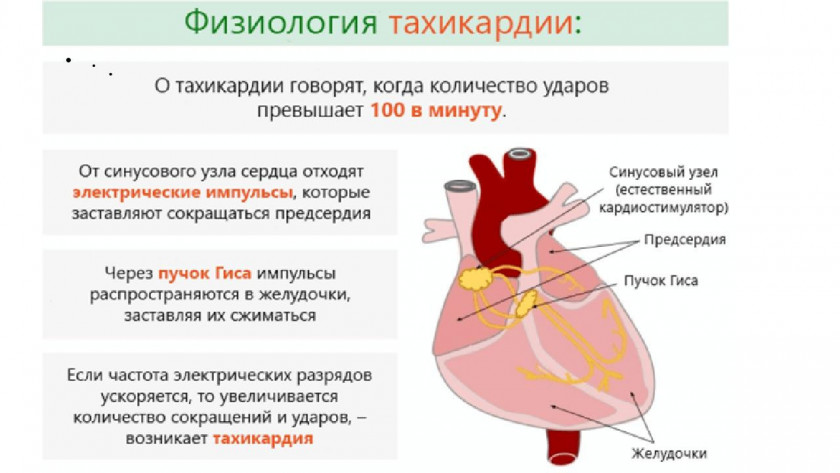 Тахикардия - Изображение 3