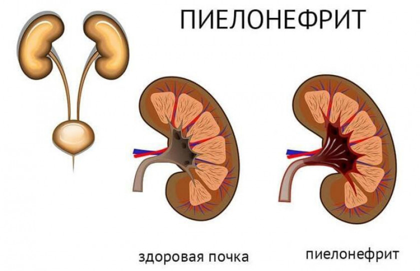 Пиелонефрит - Изображение 2