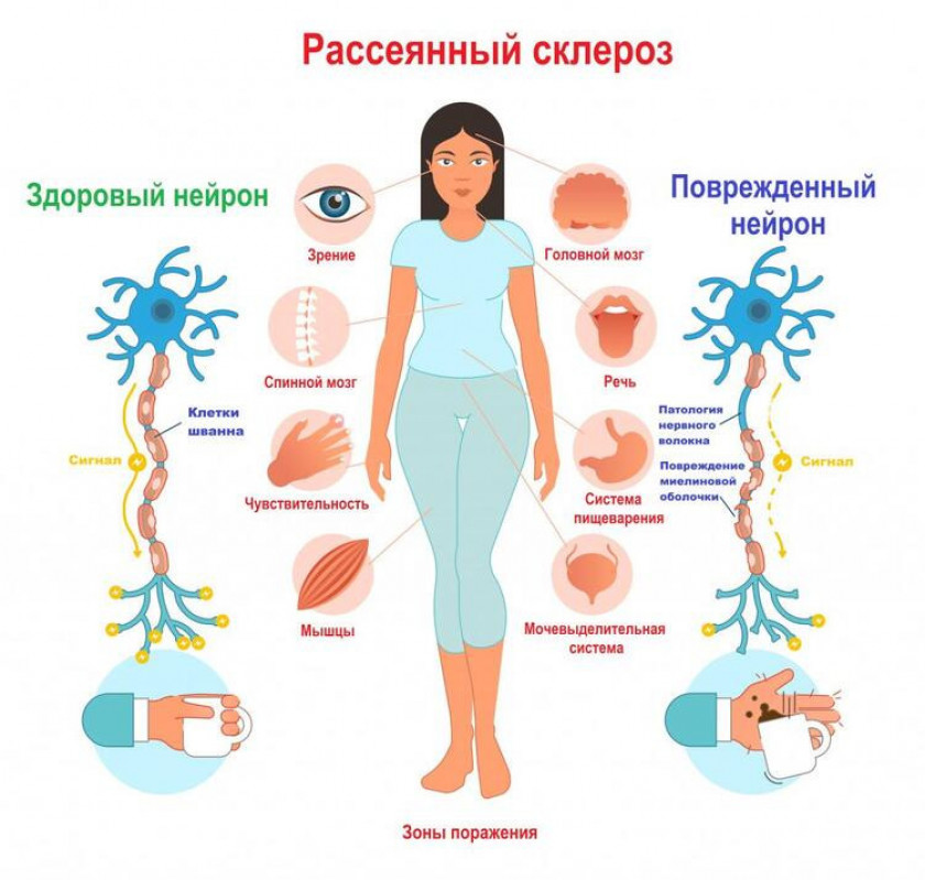 Рассеянный склероз - Изображение 1