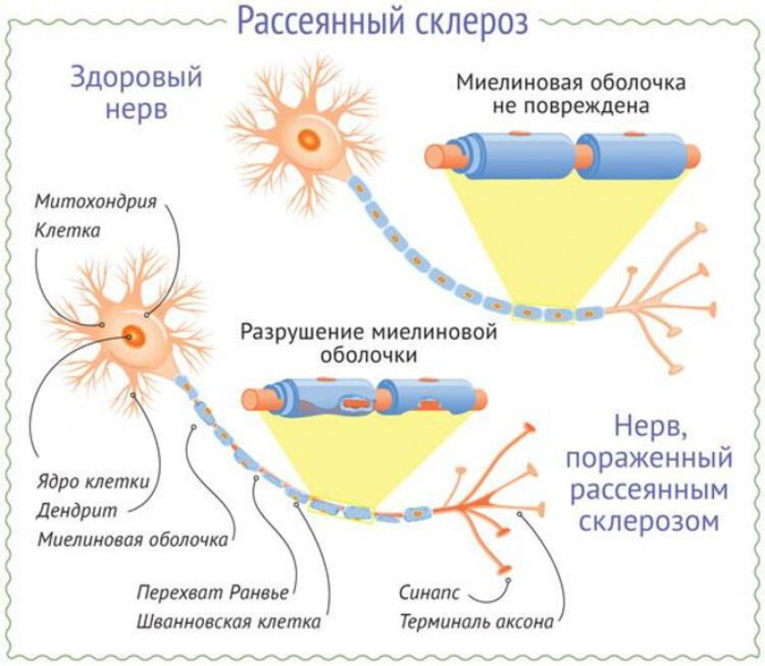 Рассеянный склероз - Изображение 4