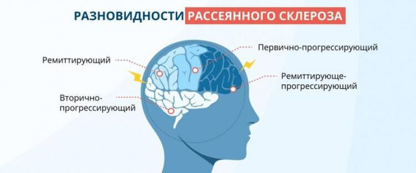 Рассеянный склероз - Изображение 2