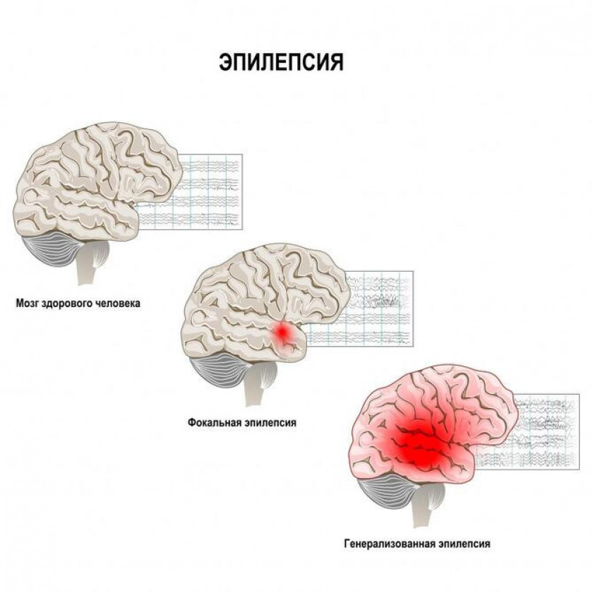 Эпилепсия - Изображение 1