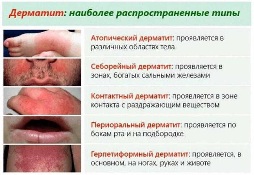 Дерматит - Изображение 3