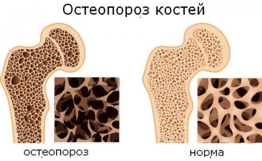 Остеопороз - Изображение 5