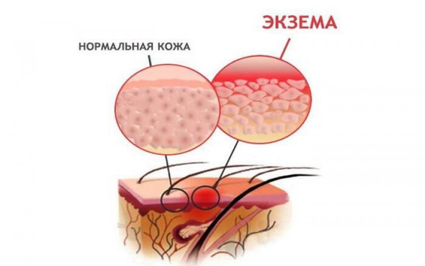 Экзема - Изображение 2