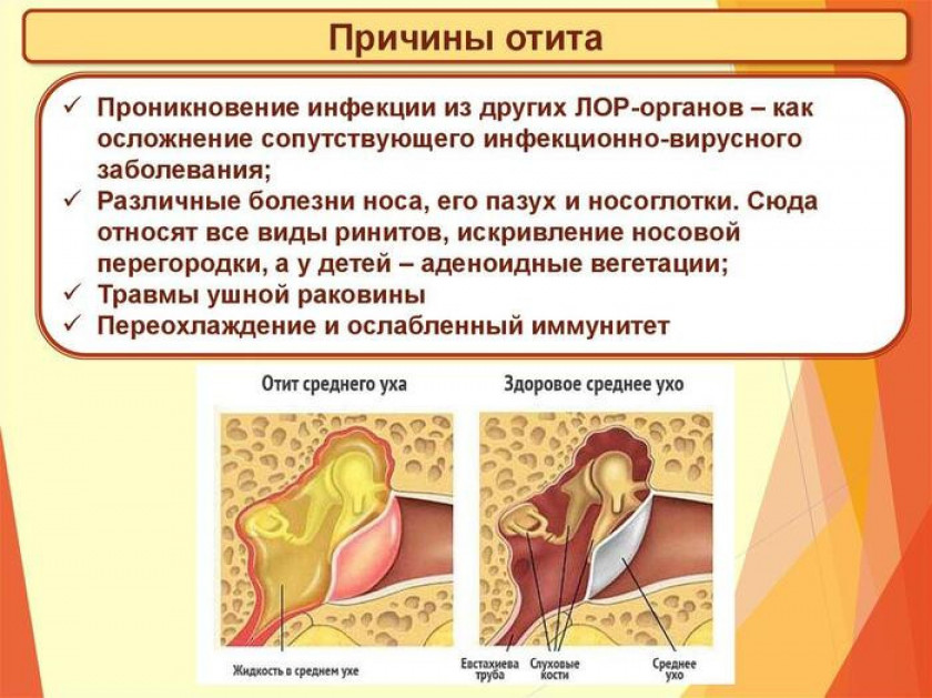 Отит - Изображение 2