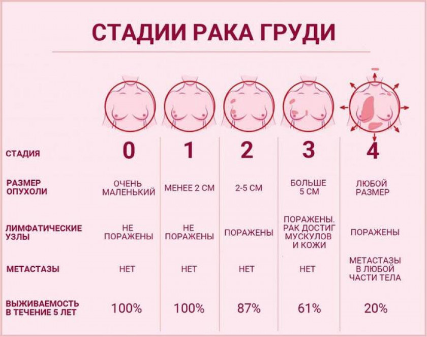 Рак молочной железы - Изображение 3