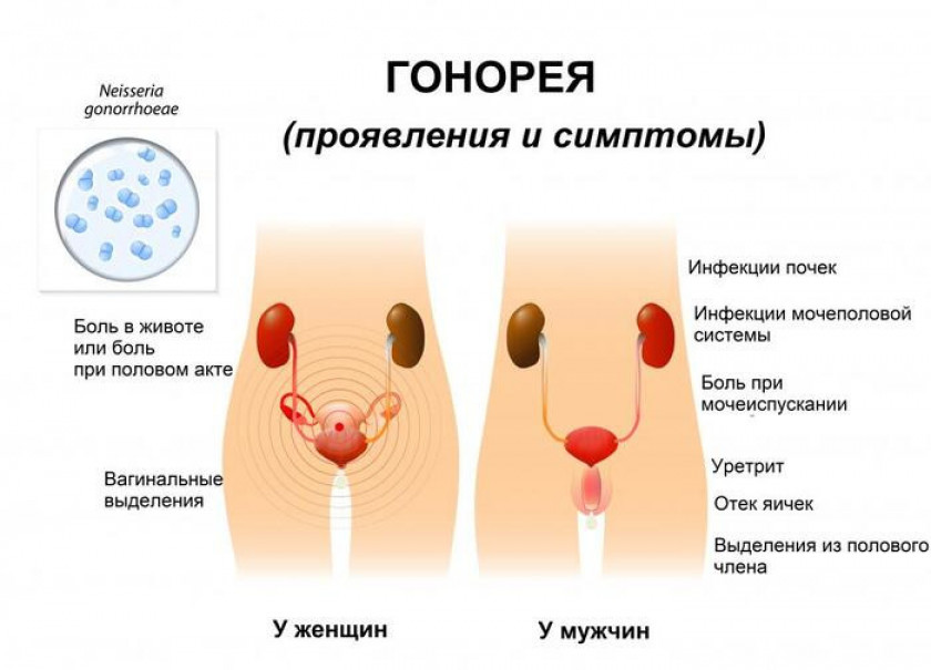 Гонорея - Изображение 3