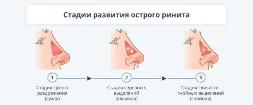 Ринит - Изображение 3