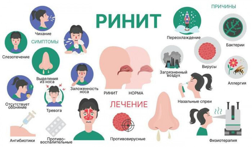 Ринит - Изображение 2
