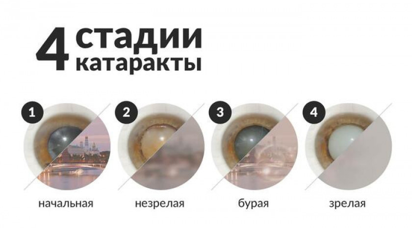 Катаракта - Изображение 4
