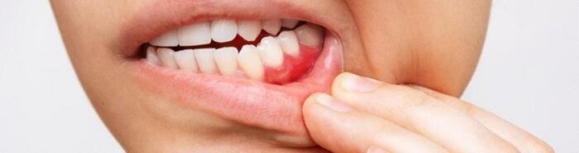 Гингивит - Изображение 1