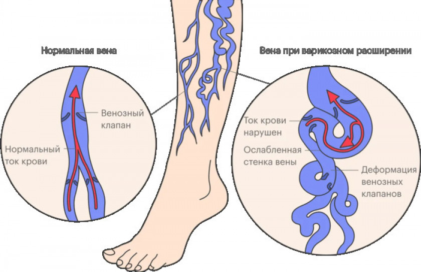 Варикоз - Изображение 3