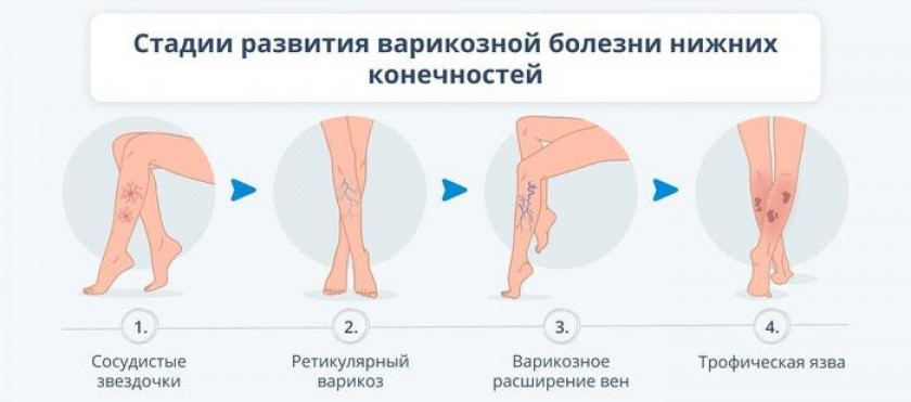 Варикоз - Изображение 2