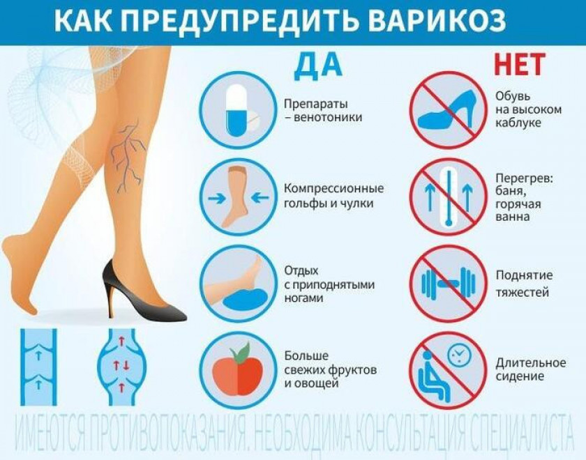 Варикоз - Изображение 5