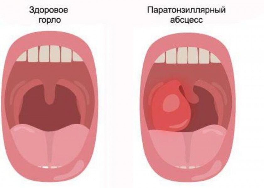 Абсцесс - Изображение 3