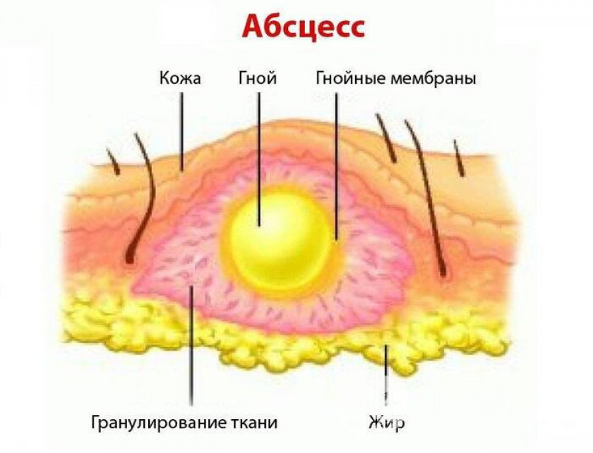 Абсцесс - Изображение 2