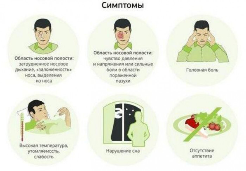 Гайморит - Изображение 3