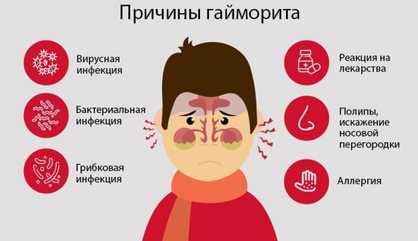 Гайморит - Изображение 2
