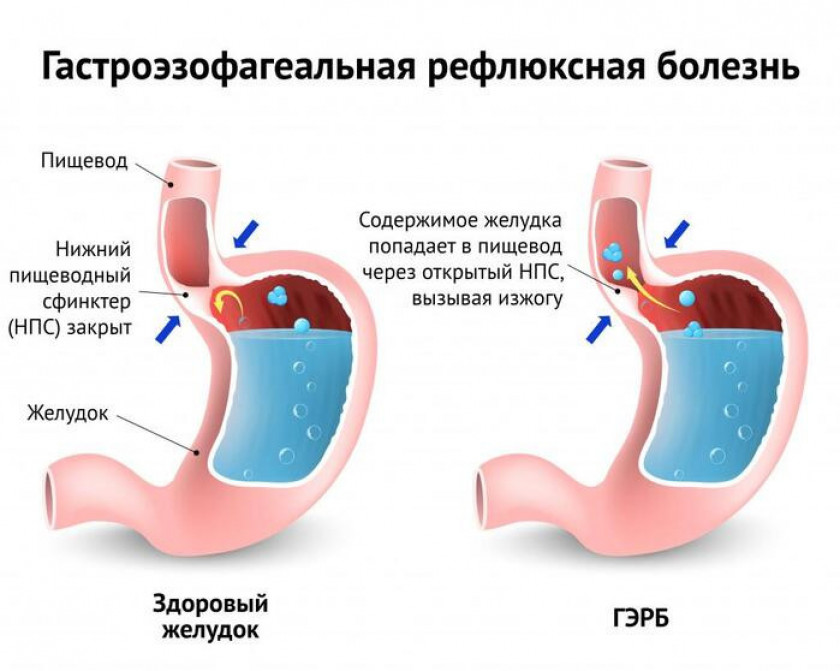 Изжога - Изображение 3
