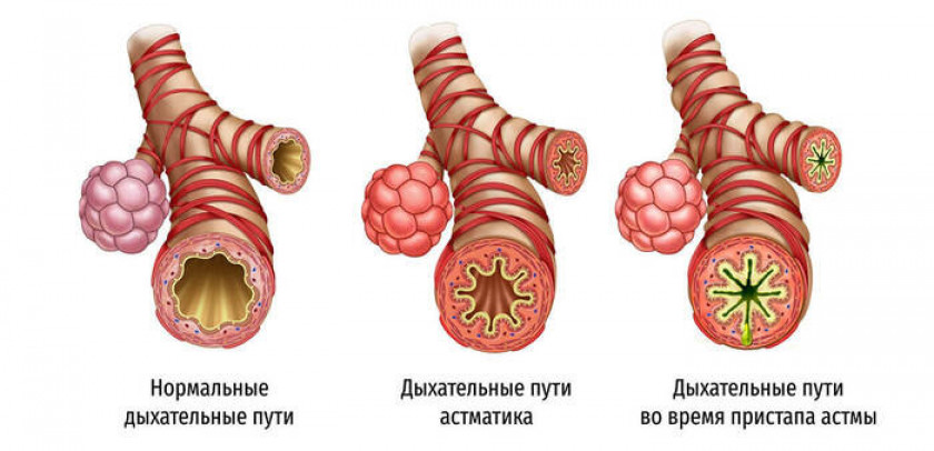 Бронхиальная астма - Изображение 1