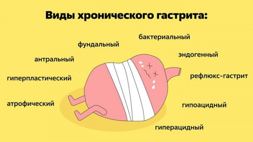 Гастрит - Изображение 4