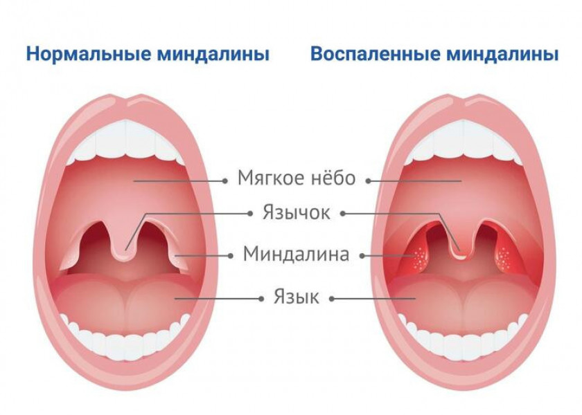 Тонзиллит: симптомы, диагностика и лечение - Изображение 1
