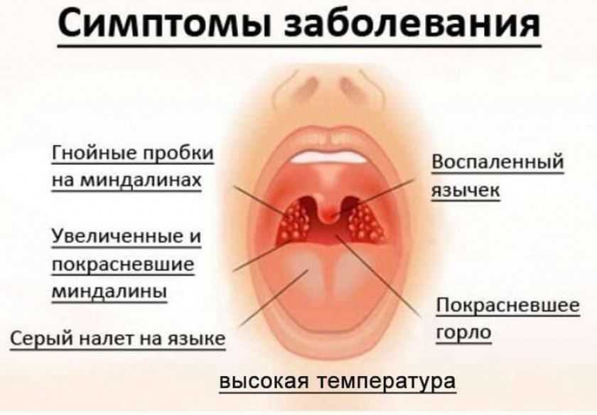 Тонзиллит: симптомы, диагностика и лечение - Изображение 2